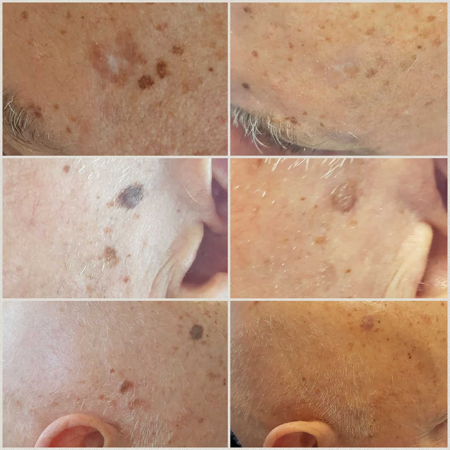 pigmentvlek gezicht voor en na de behandeling