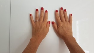 pigmentvlekken verwijderen handen na behandeling