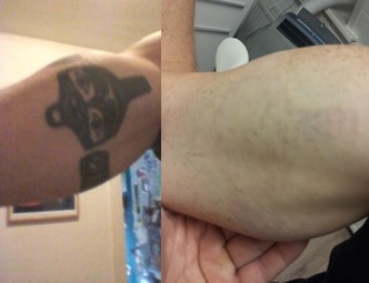 tatoeage verwijderen bovenarm