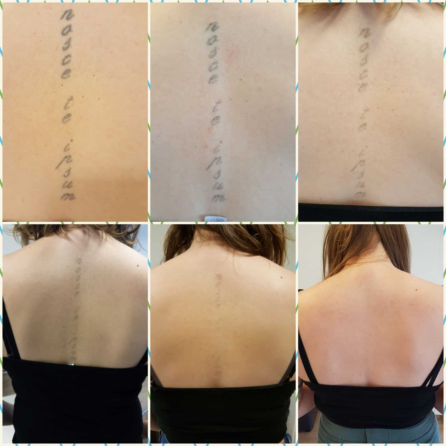 voor en na behandeling van tatoeage verwijderen